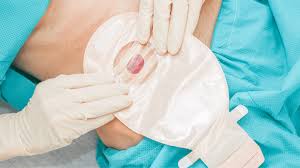Stoma Care 3
