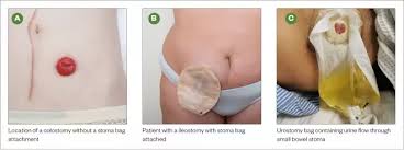 Stoma Care