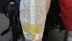 Urinary Catheter Care 1